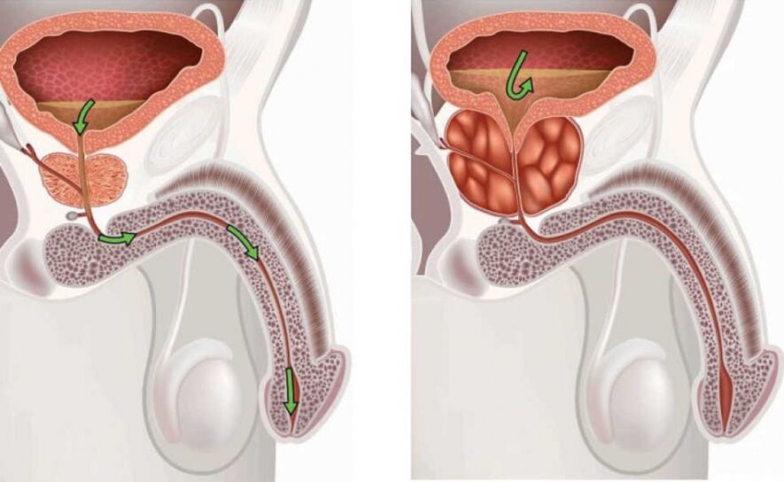 Prostatitis gaixotasunari buruzko informazioa