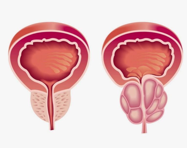 prostata osasuntsua eta gaixoa