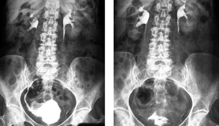 prostatitisa diagnostikatzeko urografia